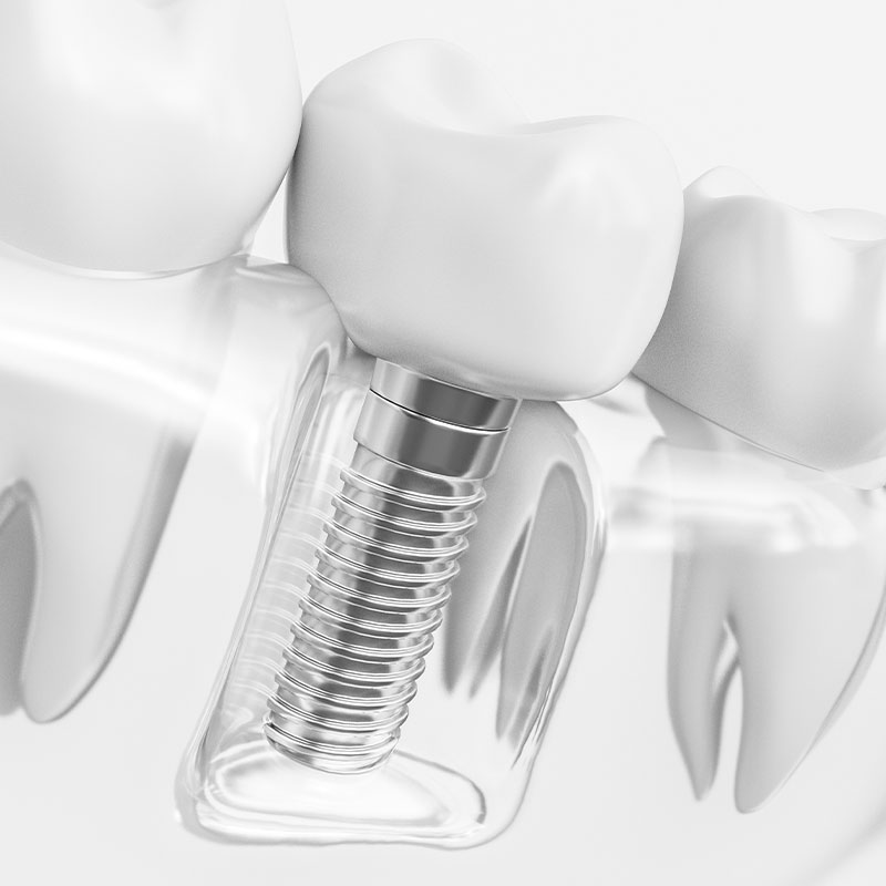 Single dental implant